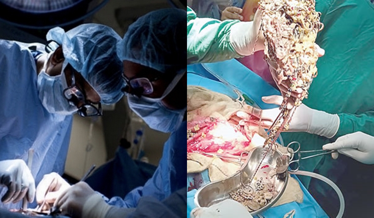 Doctors remove 69 chains, coins from stomach of 26-year-old