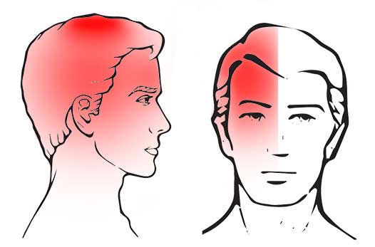 How to prevent full-blown attack of migraine headache -Expert