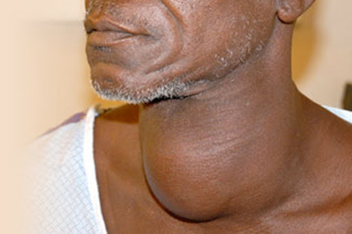 How to prevent goitre through diet -Expert
