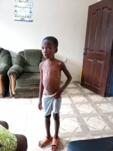 Couple burns 7 years old girl over alleged witchcraft -Police