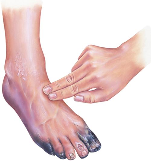 Diabetic patients prone to gangrene —Expert