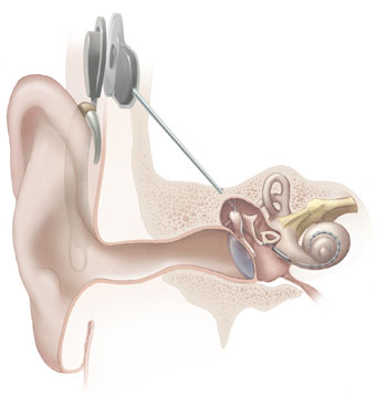 LASUTH performs 38 cochlear implants in 7 years