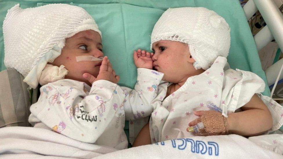 Twins conjoined at head separated after rare surgery