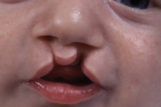 How to prevent giving birth to child with cleft lips –Speech therapist