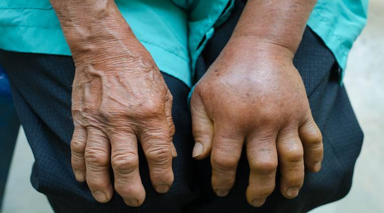 Snakebite: Why patients shouldn’t rely on traditional treatment –Expert