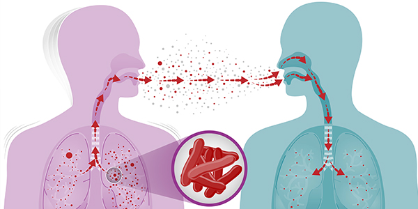 Bauchi State detects 7,806 cases of tuberculosis
