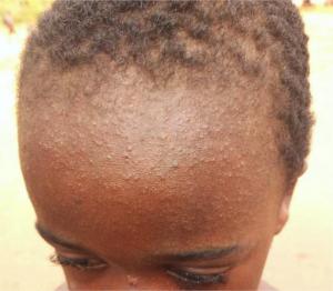 Measles kills 14 children in Anambra