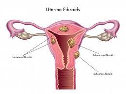 How to prevent death from fibroids –Expert
