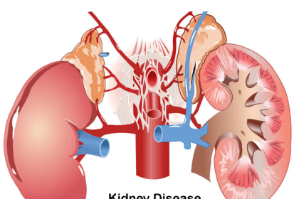 World Kidney Day: How to prevent kidney disease –Expert