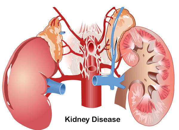 World Kidney Day: How to prevent kidney disease –Expert