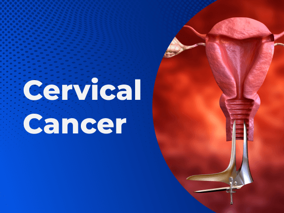 28 Nigerian women die from cervical cancer daily –Gynaecologist