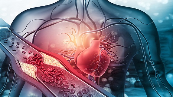 Heart failure affects over 64m people worldwide –Don