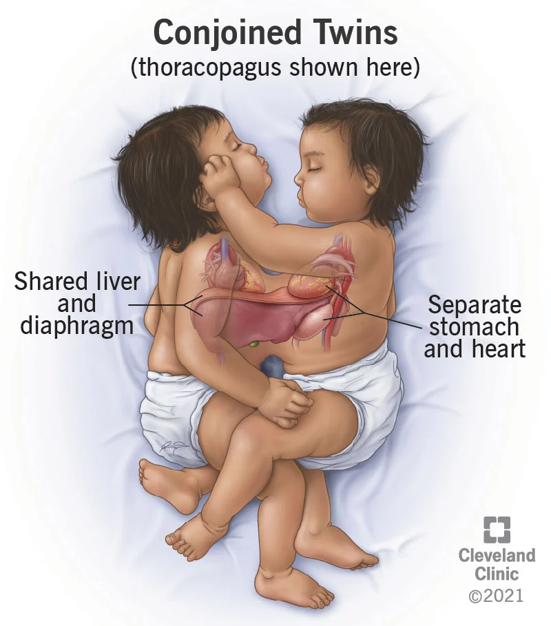 LASUTH-delivered conjoined twins die, CMD speaks