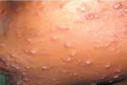 10 children die from suspected measles outbreak in FCT