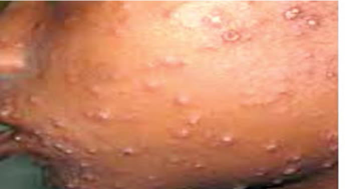 10 children die from suspected measles outbreak in FCT