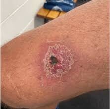 FG probes strange flesh-eating disease in Adamawa