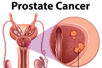 No amount of sex, special diet can prevent prostate cancer -Expert