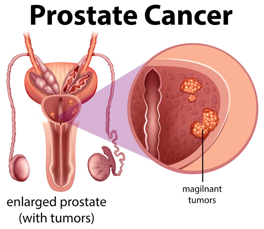 No amount of sex, special diet can prevent prostate cancer -Expert