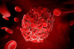 Blood clots, major cause of sudden deaths -Haematologist